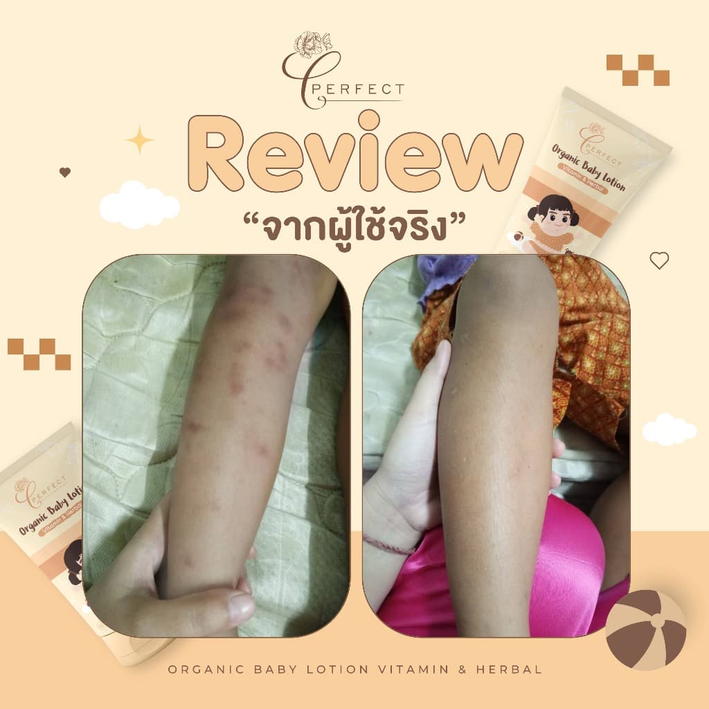 PERFECT โลชั่นเด็กออร์แกนิค บำรุงผิวขาวกระจ่างใส แก้ขาลาย ลดรอยยุงกัด กู้ผิวคล้ำเสีย - 1